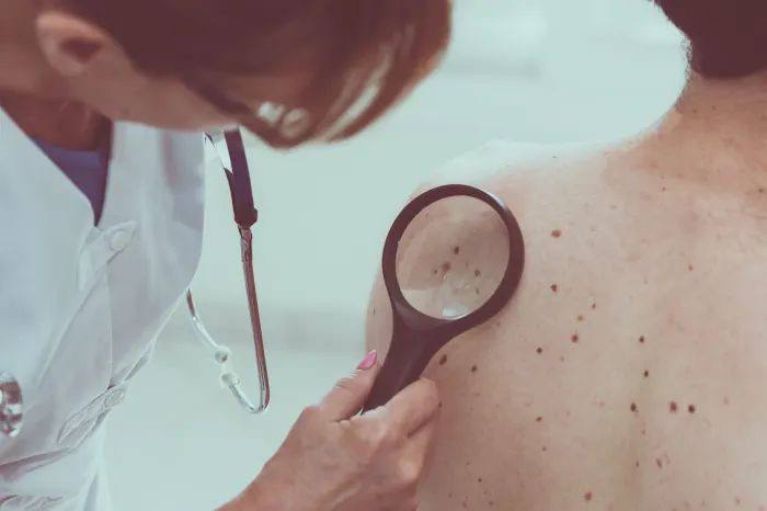 How AI can help diagnose skin cancer at an early stage